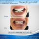 photo 2020 04 05 14 46 29 80x80 - نمونه درمانی دندانپزشکی کودکان