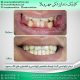 photo 2020 04 05 14 47 08 80x80 - نمونه درمانی دندانپزشکی کودکان