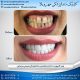 photo 2020 04 05 14 47 24 80x80 - نمونه درمانی دندانپزشکی کودکان