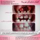 photo 2020 04 05 14 47 28 80x80 - نمونه درمانی ارتودنسی دندان