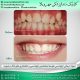 photo 2020 04 05 14 47 31 80x80 - نمونه درمانی دندانپزشکی کودکان
