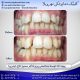photo 2020 04 05 14 47 37 80x80 - نمونه درمانی کامپوزیت دندان