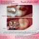 photo 2020 04 05 14 47 50 80x80 - نمونه درمانی کامپوزیت دندان