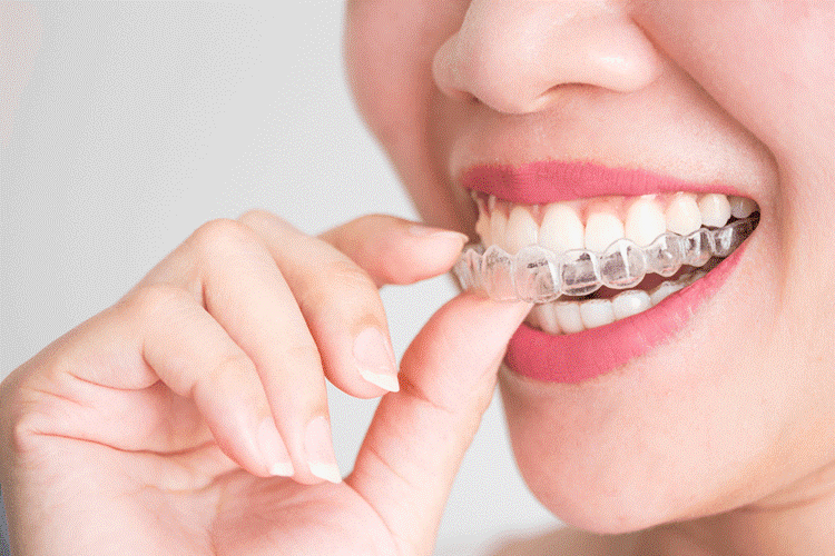 درمان دندان کج و نامرتب
