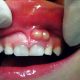11 80x80 - متخصص عصب کشی دندان در کرج