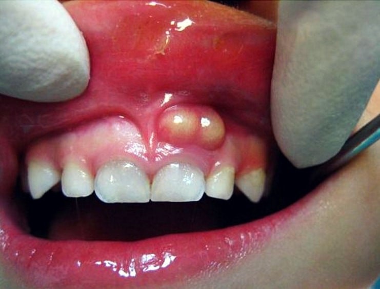11 - آبسه دندان و روش های درمان آن