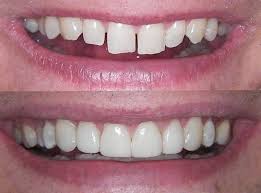کامپوزیت دندان در کرج