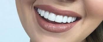 سفید کردن دندان در کرج