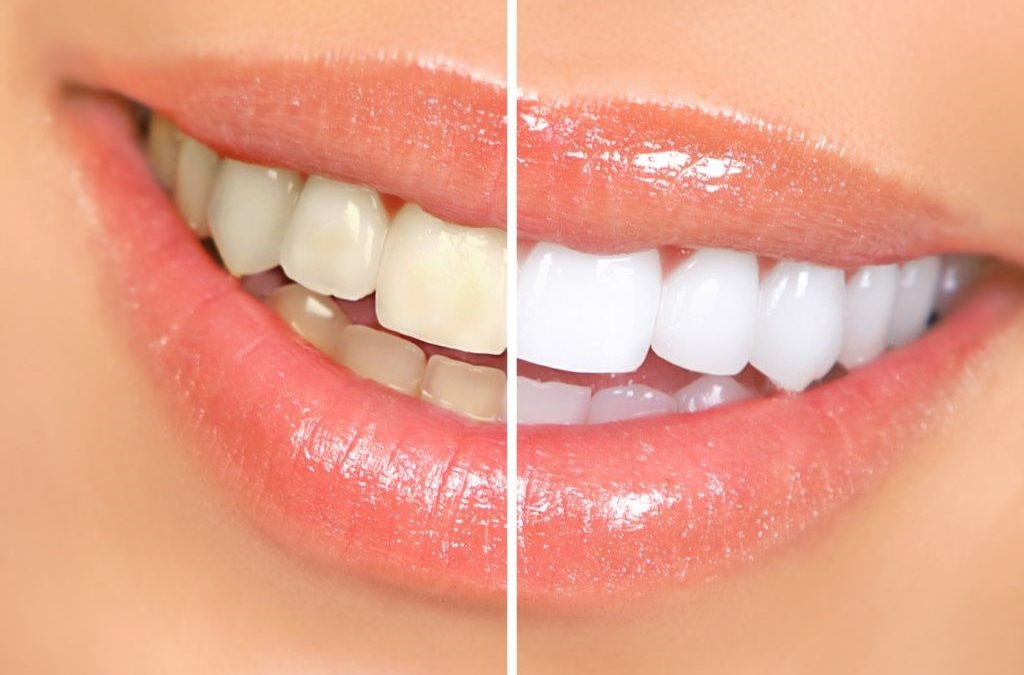 4 1 1024x675 - روش های سفید کردن دندان