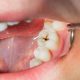 12 80x80 - انواع بی حسی و بیهوشی در دندانپزشکی