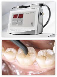 تشخیص پوسیدگی دندان با لیزر
