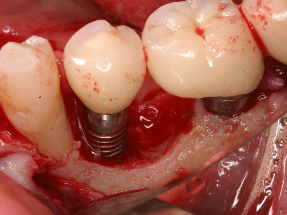1 960x720 - علائم و نشانه های عفونت ایمپلنت دندان