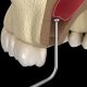 14 80x80 - آنچه باید در مورد ایمپلنت های دندانی بدانید