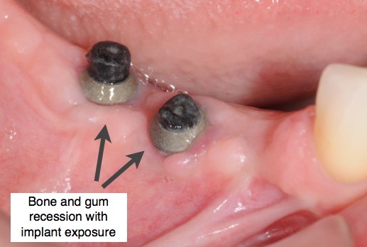عفونت ایمپلنت دندان
