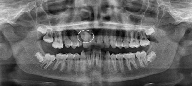 15 - نهفتگی دندان