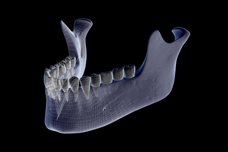 ایمپلنت دندان در بیماران پوکی استخوان