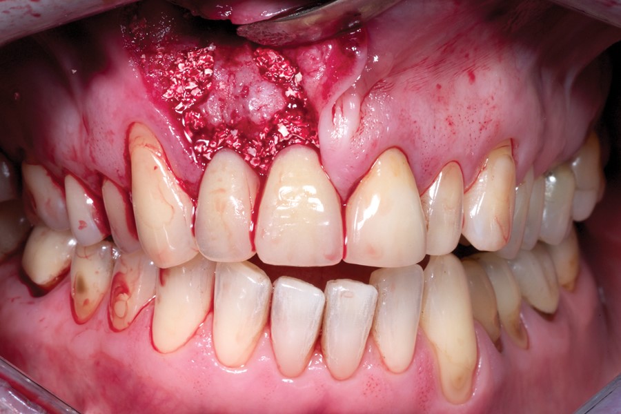 پیوند استخوان برای کاشت ایمپلنت دندانی