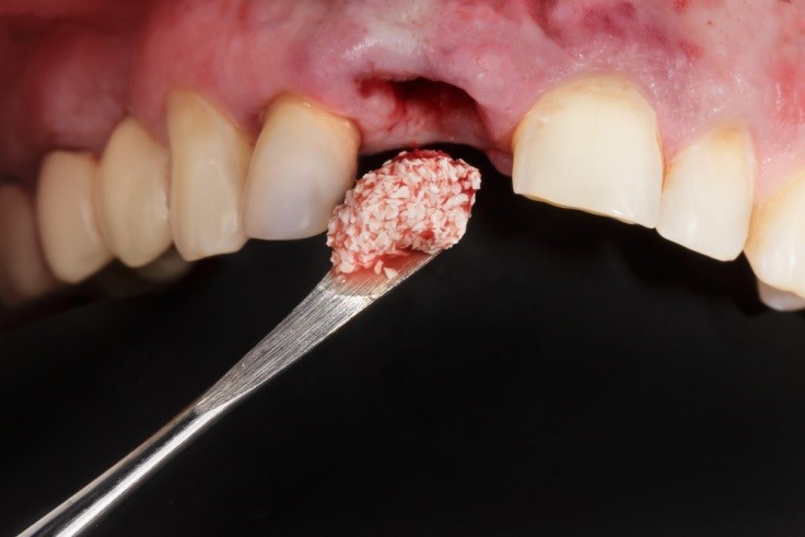 پیوند استخوان برای کاشت ایمپلنت دندانی