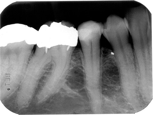 ایمپلنت دندان در بیماران پوکی استخوان