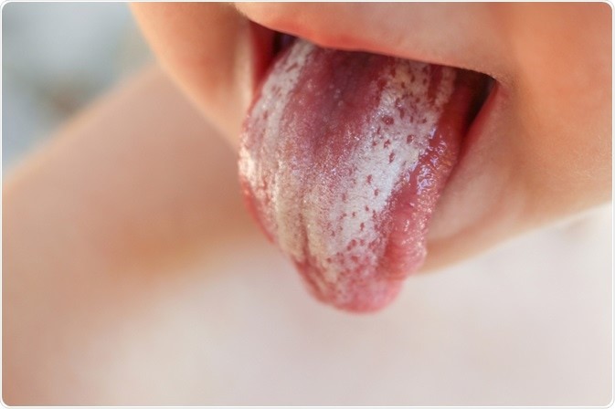 8 - برفک دهانی و روش درمان آن