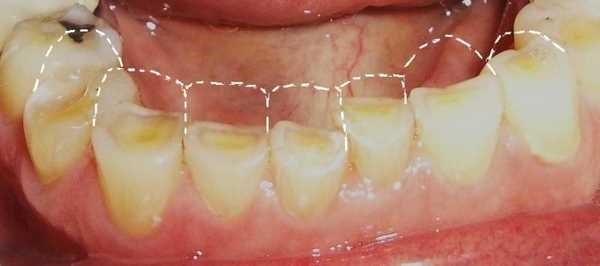15 - خطرات براکسیسم یا دندان قروچه و نحوه درمان آن