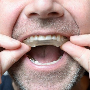  براکسیسم یا دندان قروچه