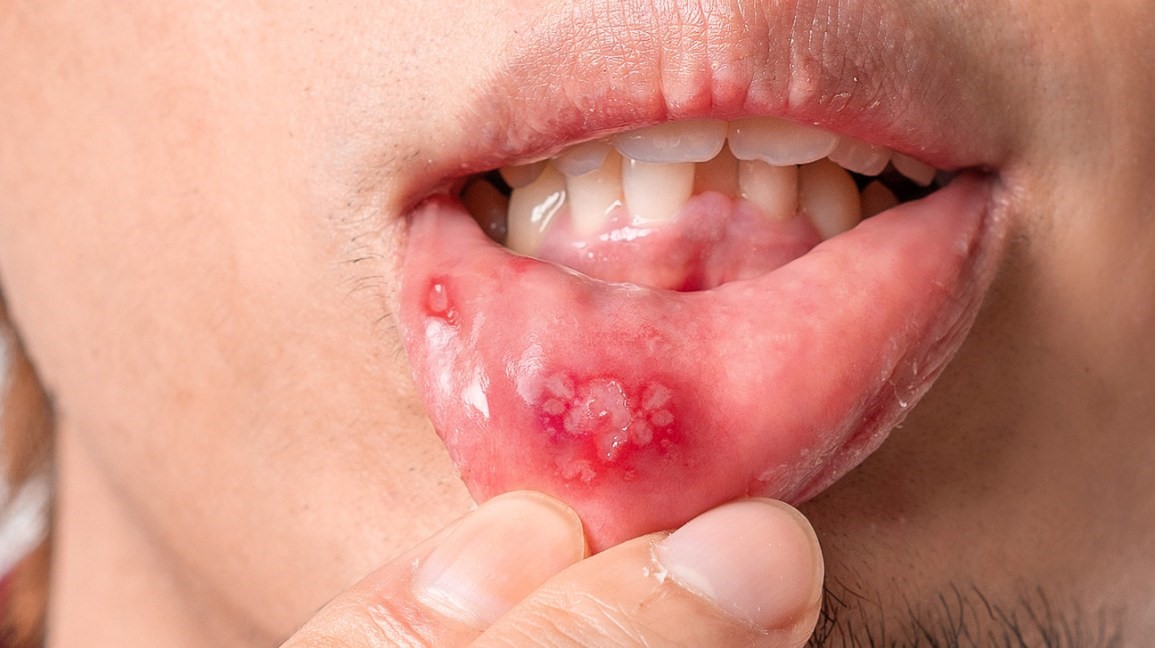 7 - علل بروز آفت های دهانی و نحوه درمان آنها