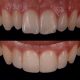 6 80x80 - آیا کاشت ایمپلنت های دندانی با بیماری لثه ممکن است؟