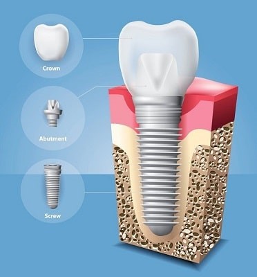 اجزاء ایمپلنت دندانی
