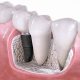 3 80x80 - چه زمانی کشیدن دندان برای ارتودنسی لازم است؟