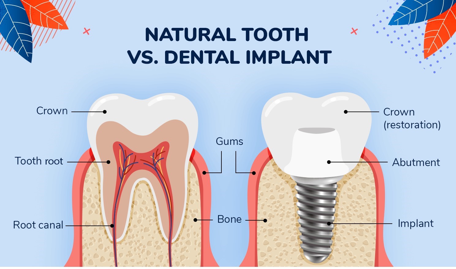 مقایسه ایمپلنت دندان با دندان طبیعی