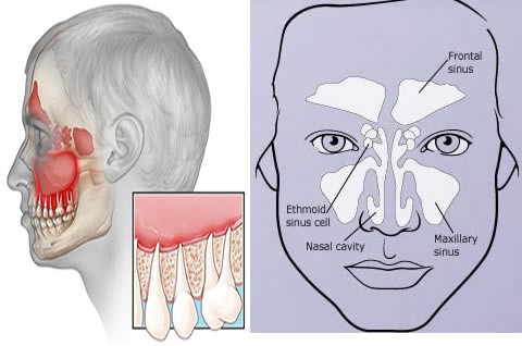 عفونت سینوس و دندان درد