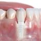 9 1 80x80 - آیا عفونت سینوس می تواند موجب بروز دندان درد شود؟