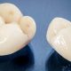 16 1 80x80 - تحلیل دندان یا تحلیل ریشه دندان چیست؟
