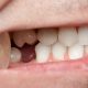 2 1 80x80 - آیا ممکن است روکش دندان لق شود؟ چه باید کرد؟