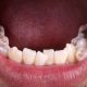 1 80x80 - تحلیل دندان یا تحلیل ریشه دندان چیست؟