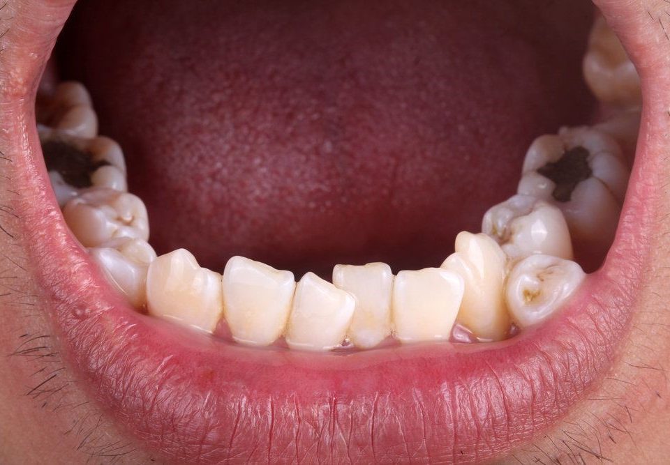 1 960x667 - هایپردنشیا یا دندان اضافی داخل دهان