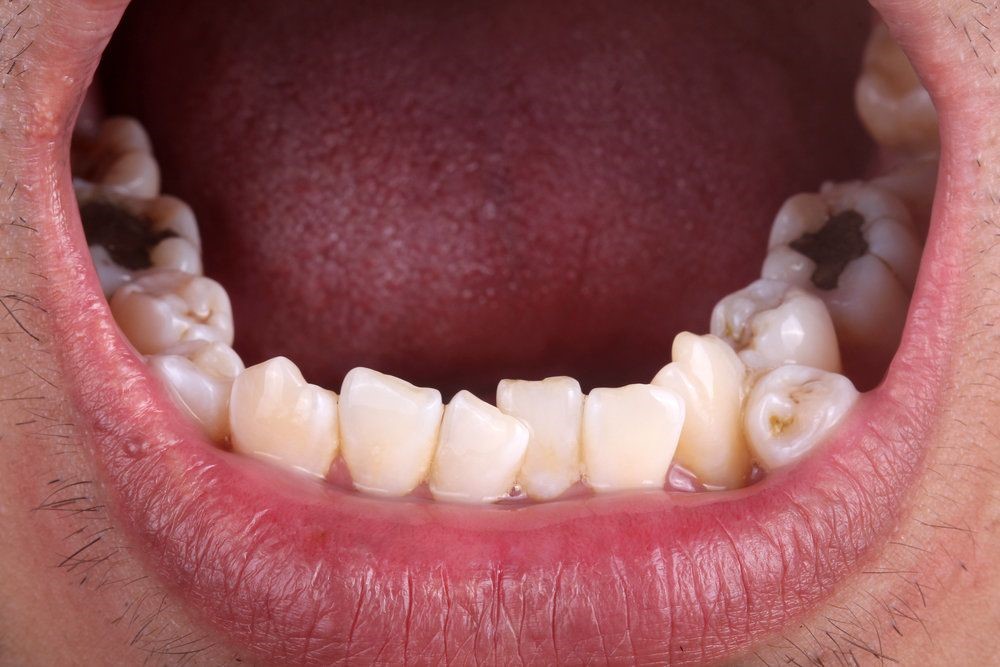 1 - هایپردنشیا یا دندان اضافی داخل دهان