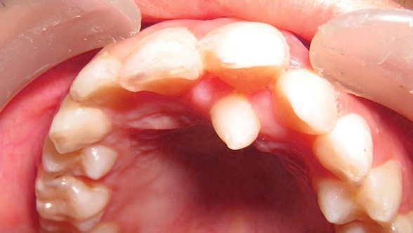 هایپردنشیا یا دندان اضافی داخل دهان