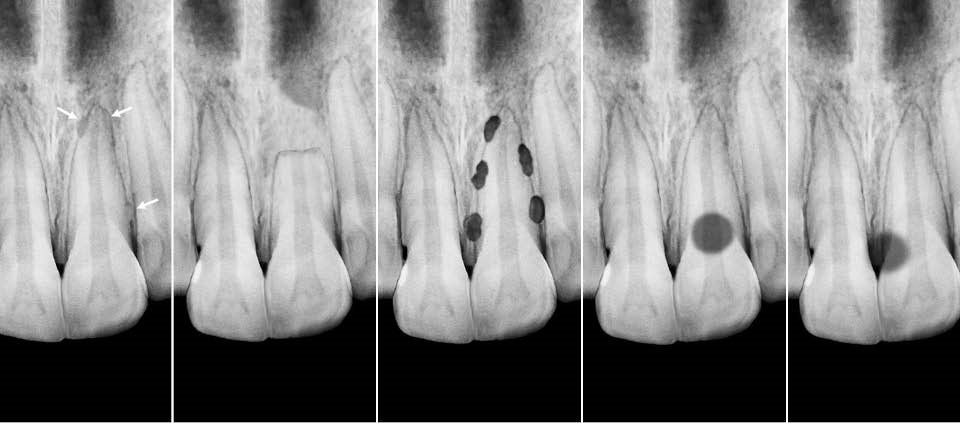 8 960x423 - تحلیل دندان یا تحلیل ریشه دندان چیست؟