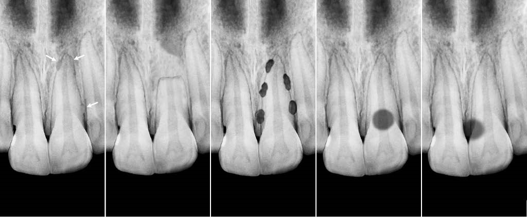 8 - تحلیل دندان یا تحلیل ریشه دندان چیست؟