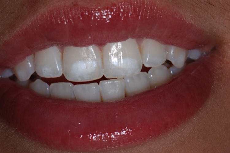 5 - آنچه باید در مورد کمبود کلسیم و دندان ها بدانید!