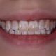 9 80x80 - در صورت خارج شدن پر شدگی دندان چه باید کرد؟
