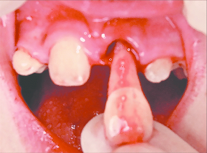 10 - هنگام کنده شدن یا خارج شدن دندان از حفره چه باید کرد؟