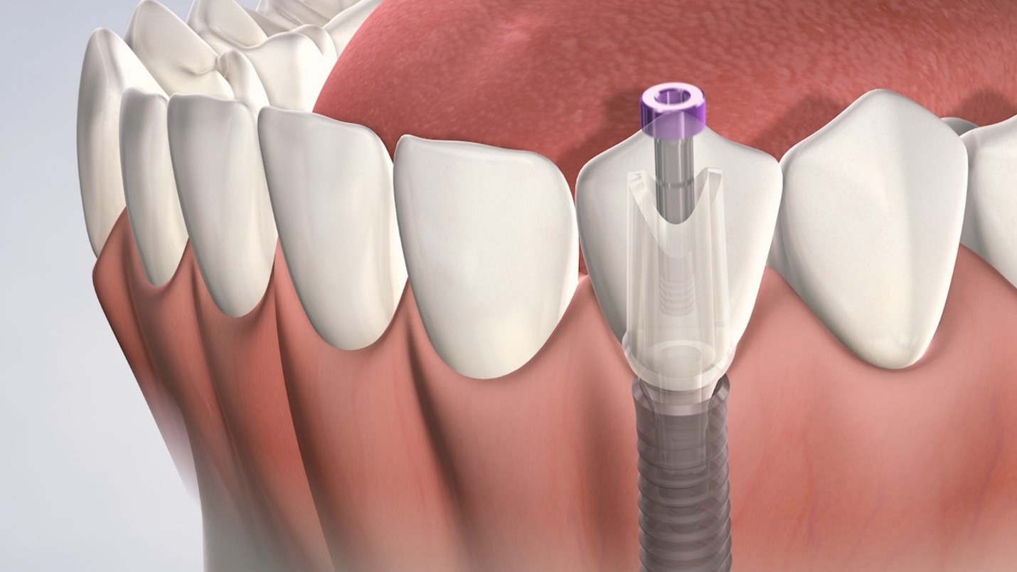 فرایند کاشت ایمپلنت دندانی