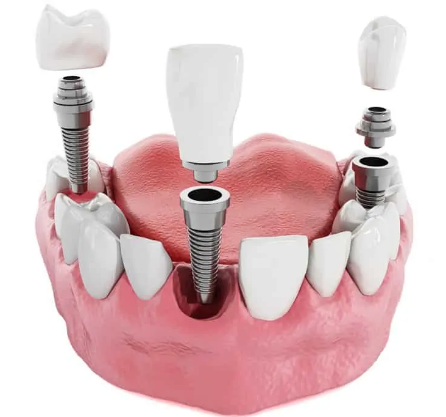 فرایند کاشت ایمپلنت دندانی
