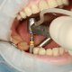 7 80x80 - آیا دریافت ایمپلنت های دندانی درد دارد؟