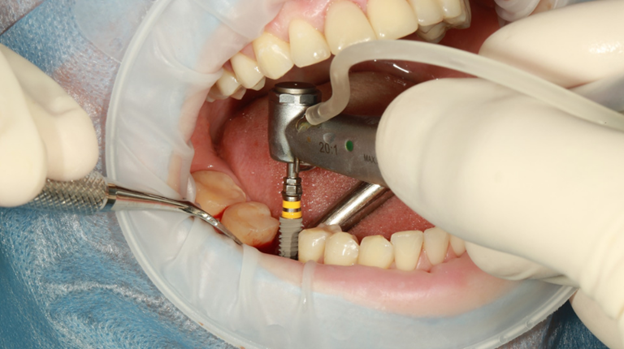 7 - چه مدت پس از کشیدن دندان می توان ایمپلنت دندانی کاشت؟