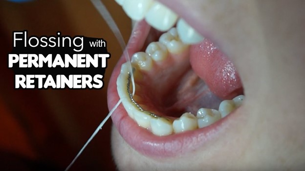 20 - راهکارهایی برای نخ دندان کشیدن با نگهدارنده های ثابت