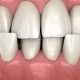 15 80x80 - آیا دندان های شما بعد از پر کردن حساس شده اند؟